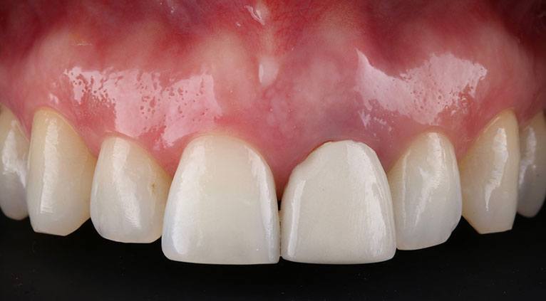 Clínica Beleza do Sorriso - Reabilitação com implantes