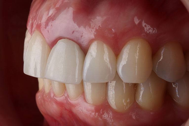 Clínica Beleza do Sorriso - Reabilitação com implantes